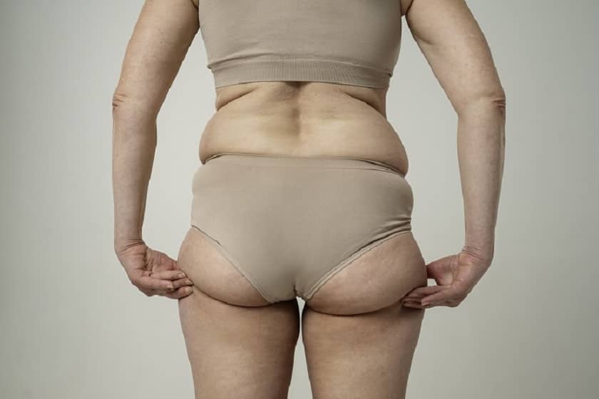 Definición y características del lipedema-