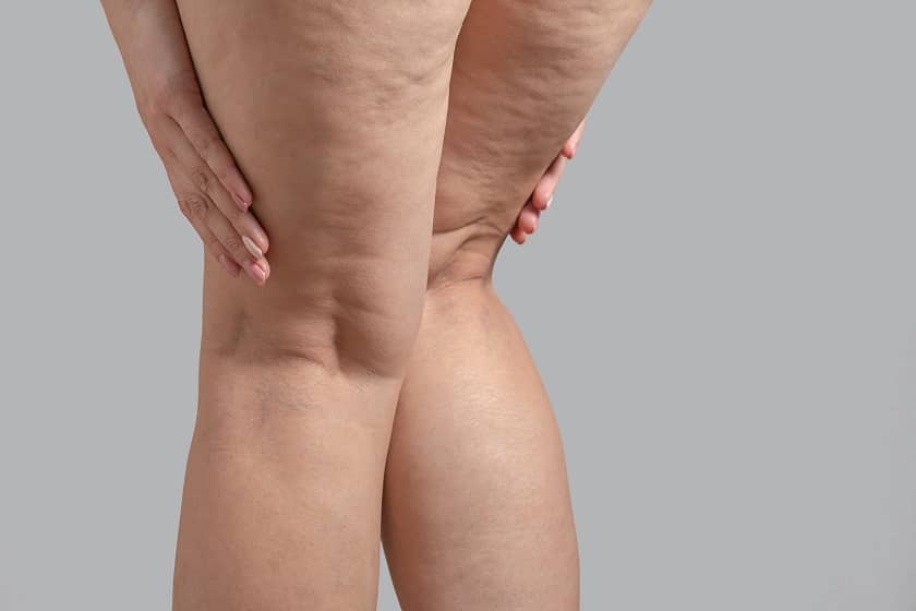 El Abordaje Nutricional en el Tratamiento del Lipedema