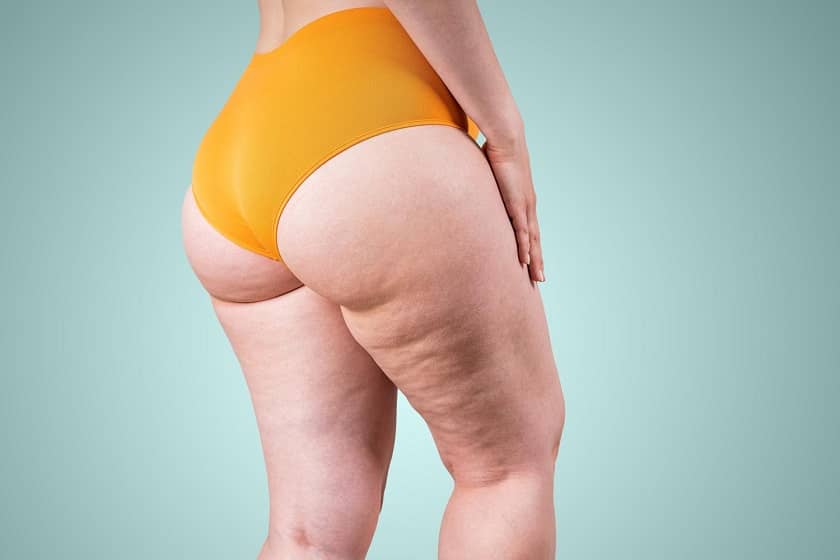 Lipedema y Su Abordaje Nutricional